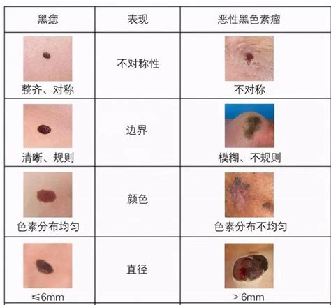 腋下旁邊有痣|腋下黑痣是否需除？如何處理？